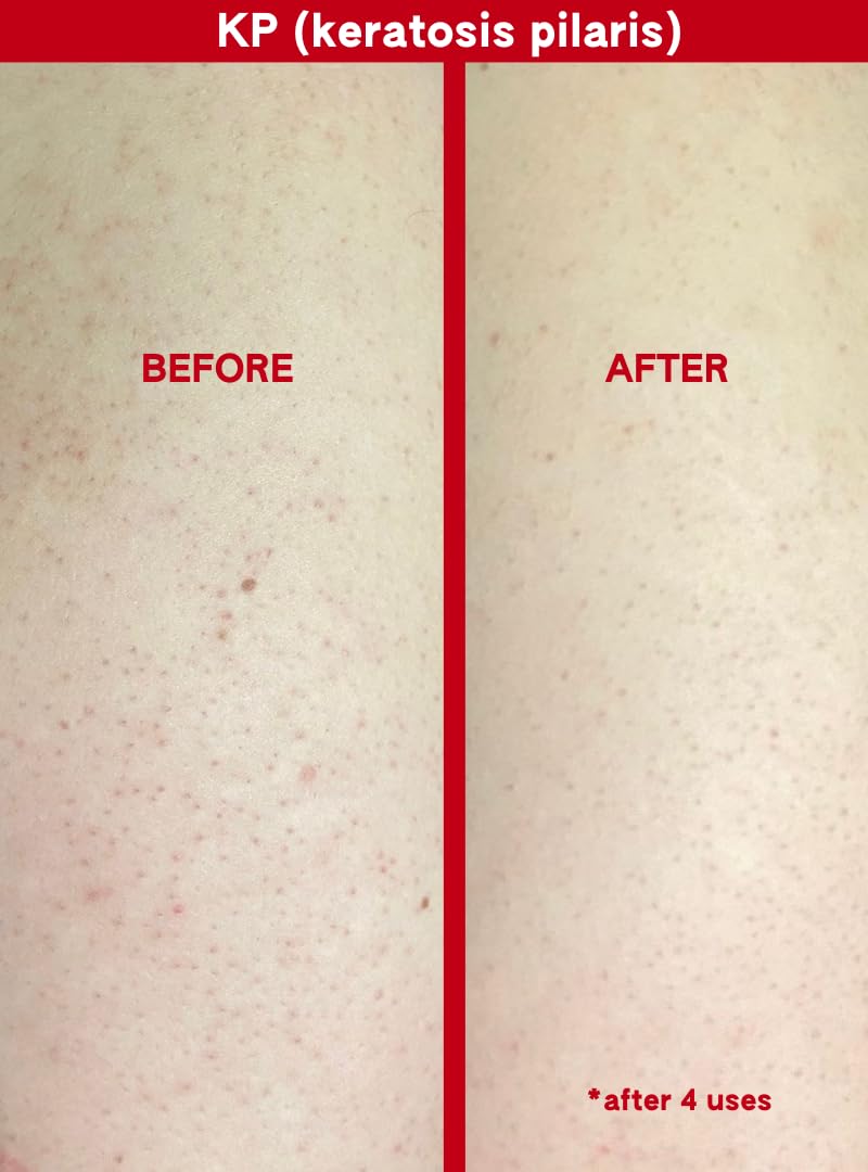 ABI AME ingredient close-up highlights glycolic and salicylic acids