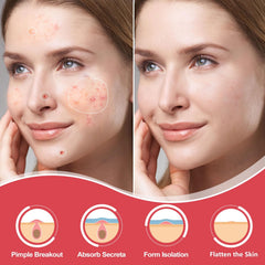 AcneGo hydrocolloid patch sticks securely for overnight wear.
