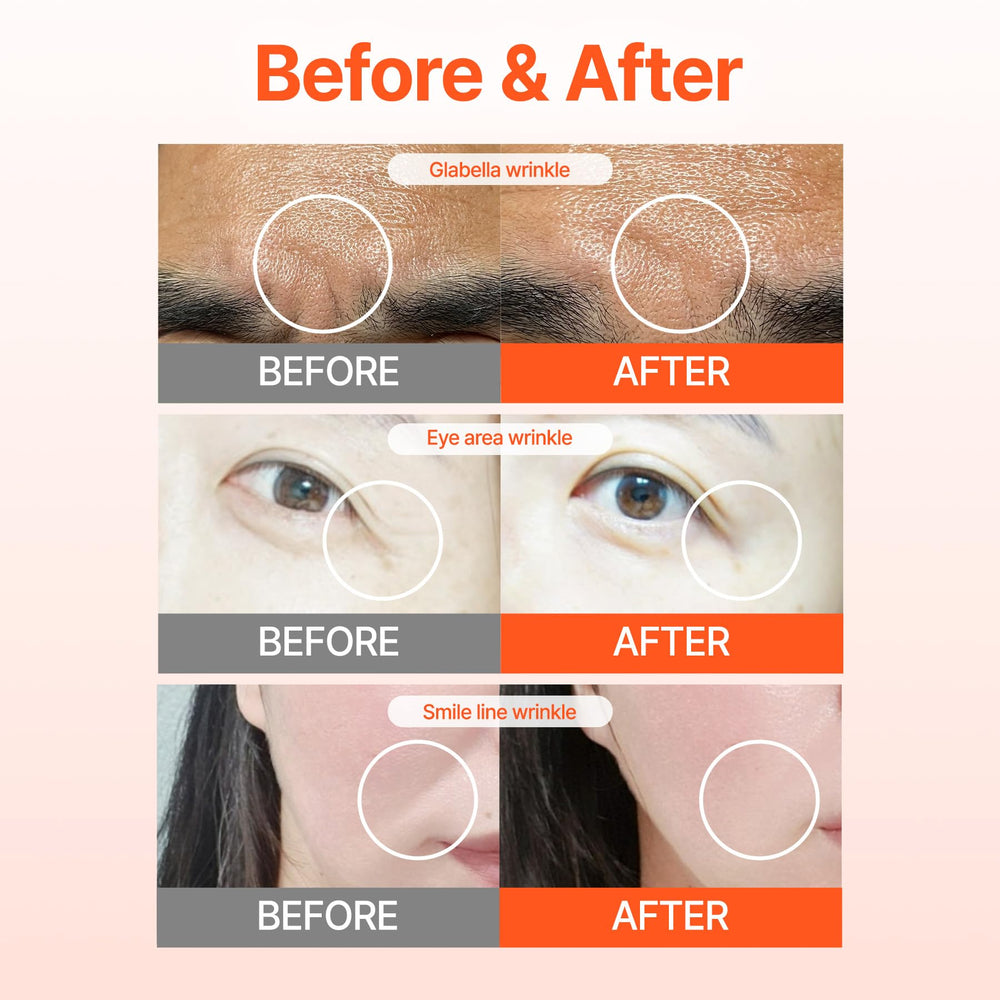 Acropass RETI-RN patch applied near the eye area for precision coverage