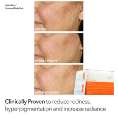Extra Strength Peel tubes shown for deeper resurfacing potential.