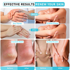 Aphesia Urea 40% vitamin blend with E, B6, Niacinamide for skin support.