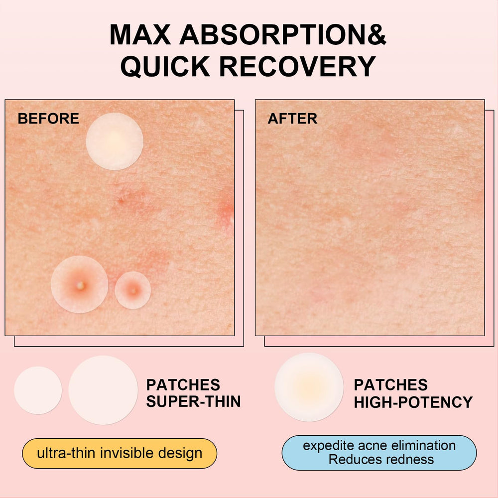 AVJONE absorbent zit patches help faster relief and cleaner skin