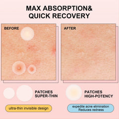 AVJONE absorbent zit patches help faster relief and cleaner skin