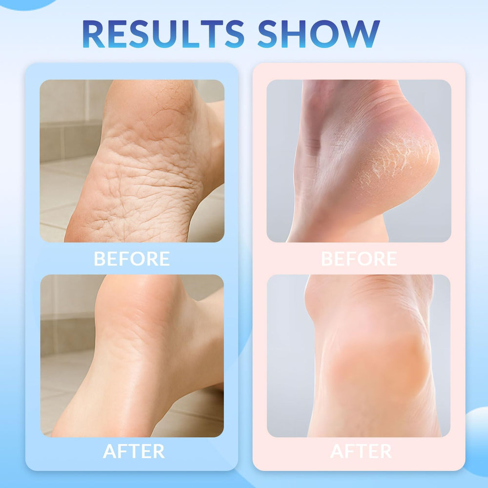 Awjsde rough skin to smooth foot texture shows transformation after use