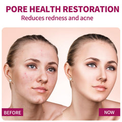 Azelaic Acid Serum on skin shows gentle daily use for balanced tone.