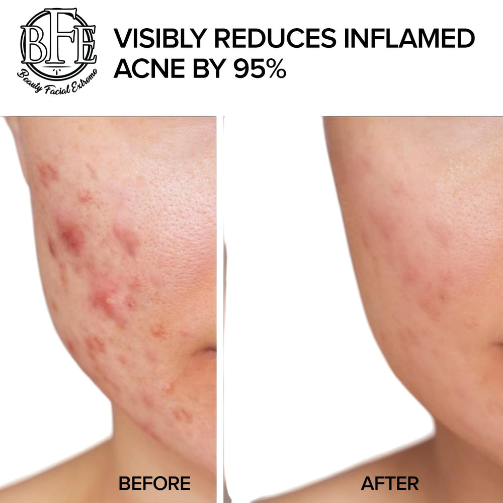 Beauty Facial Extreme Acne Pad application on skin showing pore cleansing.