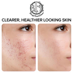 Beauty Facial Extreme Acne Pad close-up of pores benefiting oil regulation.