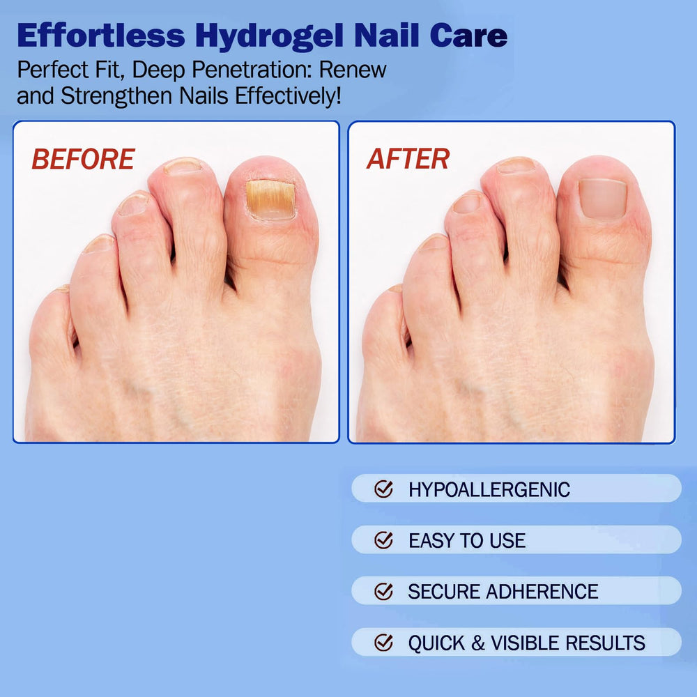 BFGCKJ patch on nail bed supporting moisture balance