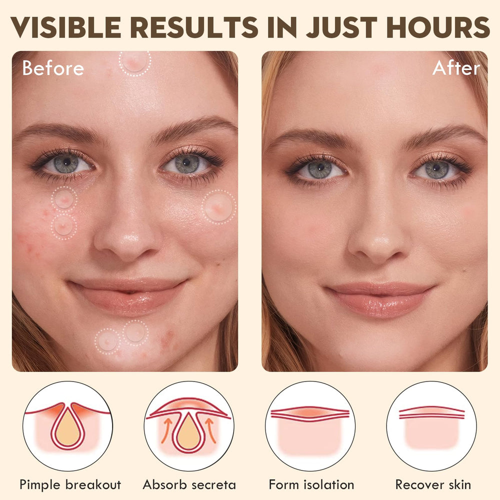 Blorfo salicylic acid acne patches on blemish for targeted care and absorption.