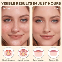 Blorfo salicylic acid acne patches on blemish for targeted care and absorption.