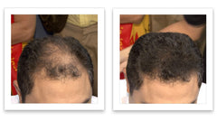 Caboki concealer general thinning disguises thinning areas.