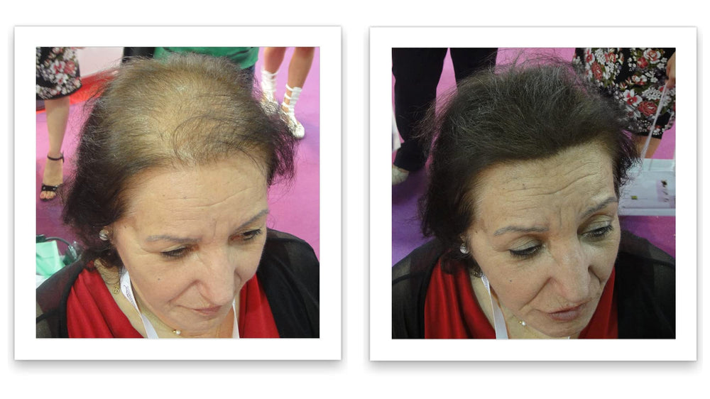Caboki concealer sparse hairline restores volume at front.