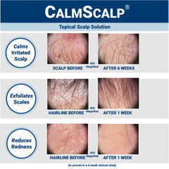 CalmScalp bottle-pour highlighting convenient, targeted scalp application