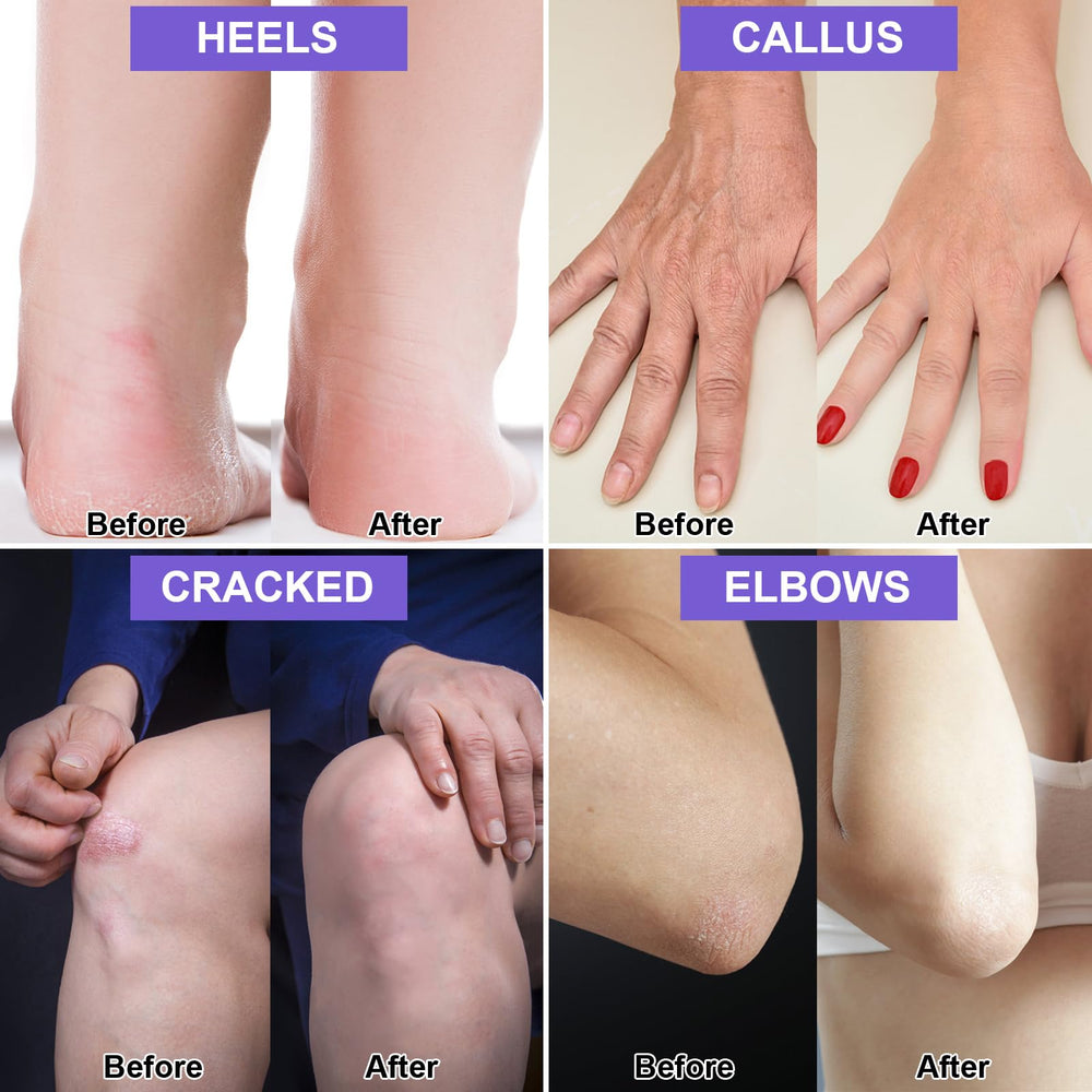 Charmonic cracked heels before and after scene highlighting smoother skin
