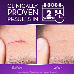 Cicatricure Advanced Scar Gel application area on clean skin showing use.