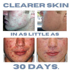 Clearogen lotion packaging label highlighting paraben-free formula