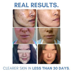 Clearogen sulfur acne lotion 1.8 oz bottle in consumer packaging