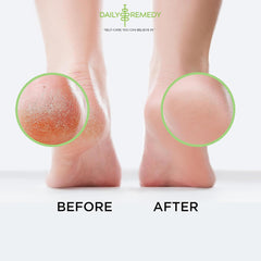 Daily Remedy Foot Soak helps with athlete's foot and calluses