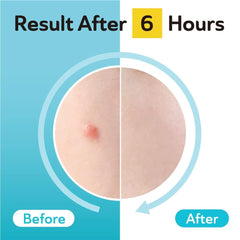 DERMA ANGEL 96-patches pack for ongoing blemish care.
