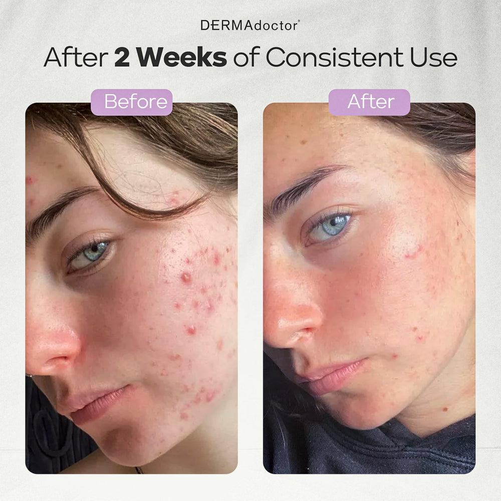 DERMAdoctor Ain't Misbehavin acne treatment helps manage oil and blackheads.