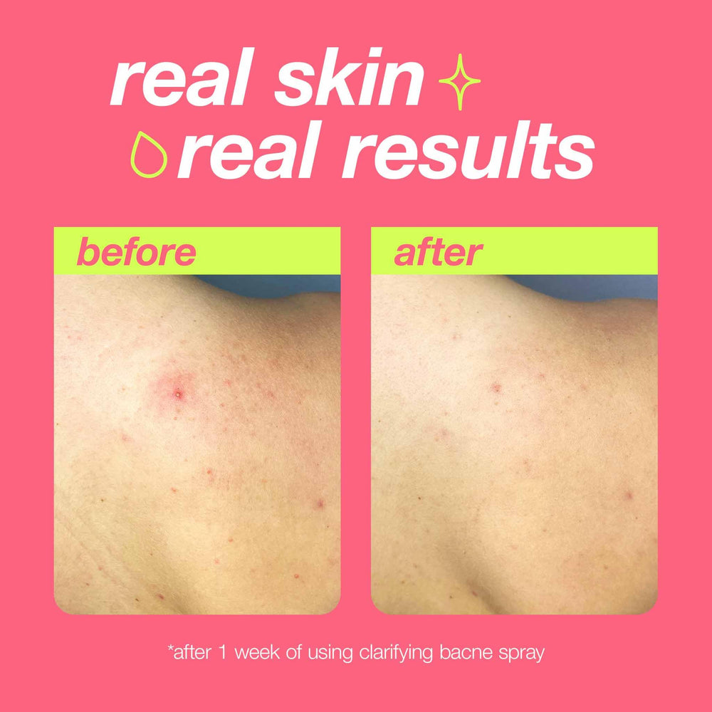 Dermalogica Tea Tree Oil soothes redness and irritation reduction.