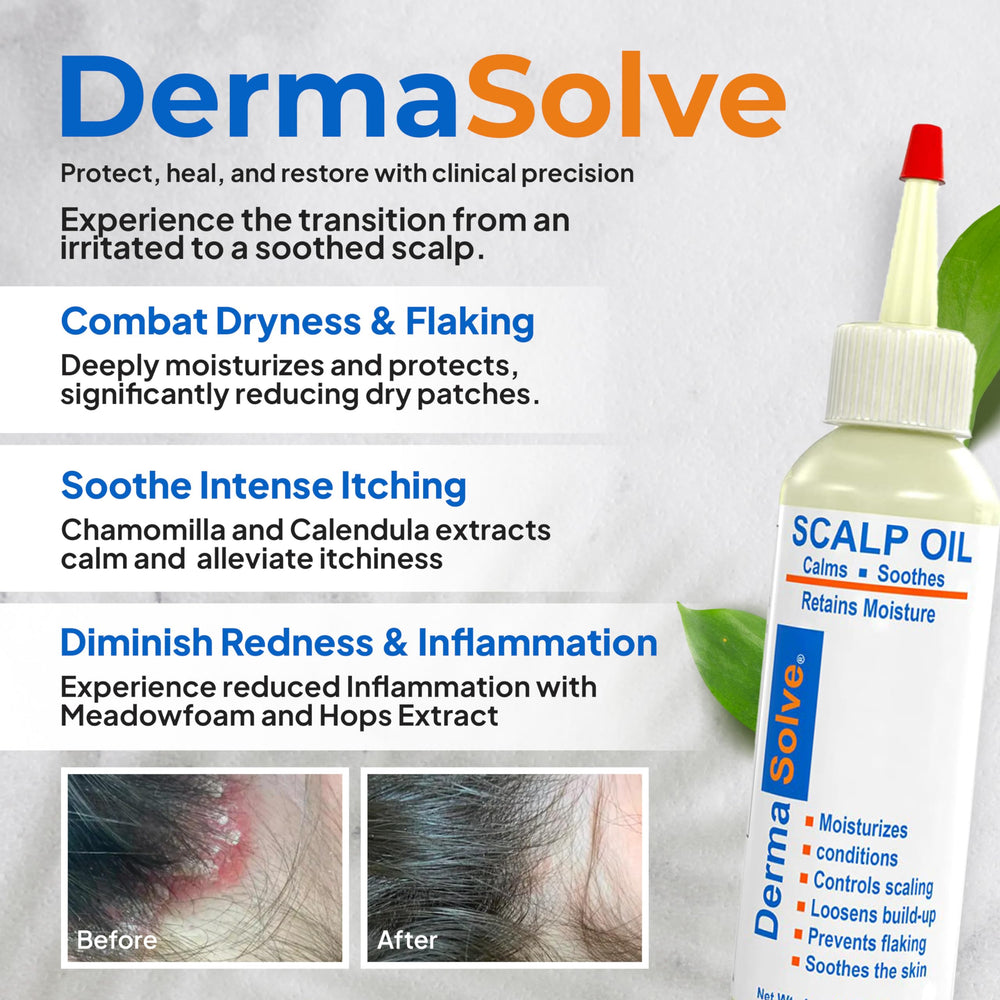 Dermasolve Psoriasis & Dandruff Oil application on scalp for soothing relief
