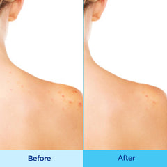 Hands applying Differin to back with even coverage