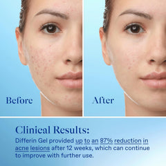 Adapalene 0-1 percent concentration shown in product description