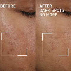 Gel applied directly to a dark spot for targeted treatment