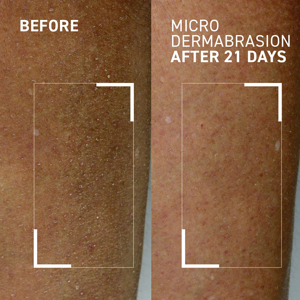 Elbows rough skin pre-treatment with Dr. Brandt exfoliator for smoother texture