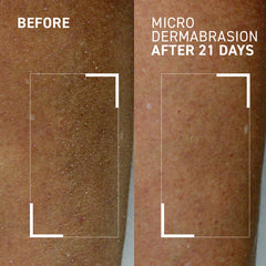 Elbows rough skin pre-treatment with Dr. Brandt exfoliator for smoother texture