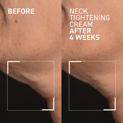 Dr Brandt neck area before and after view highlighting sag reduction.