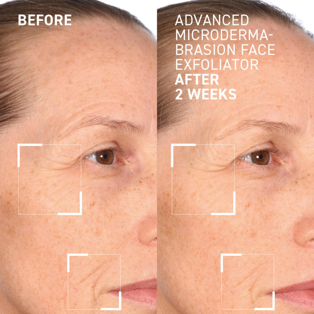 Lactic acid exfoliation for renewed texture and smoother skin.