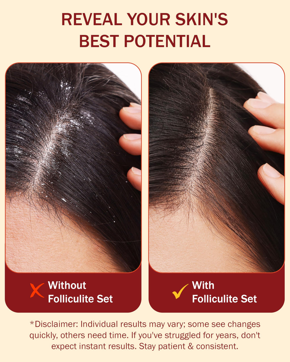 e70 Folliculitis Body Spray mist targets blemishes on torso and limbs