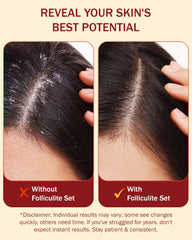 e70 Folliculitis Body Spray mist targets blemishes on torso and limbs