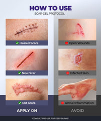 EaseWave stretch-mark and scar care close-up with smoother skin texture.
