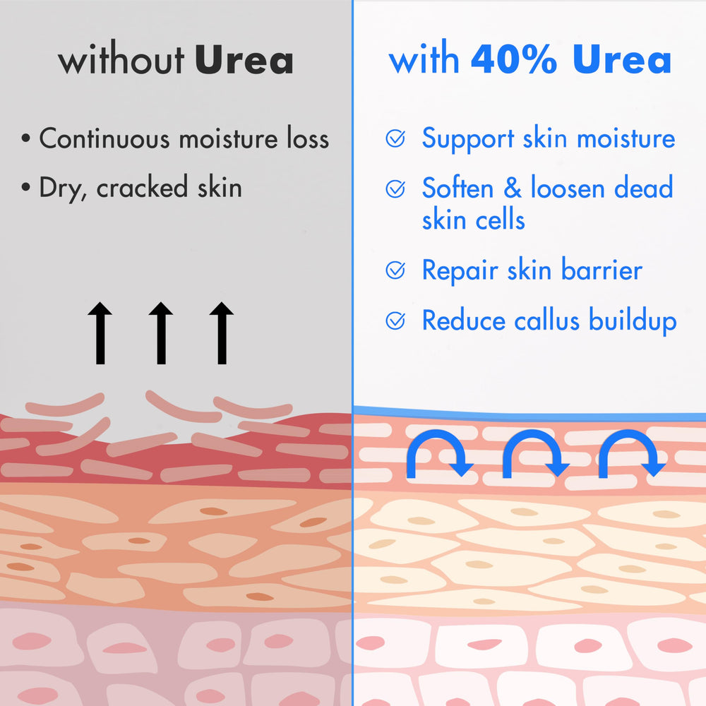 Ebanel Urea Cream 40% on heel care and rough skin