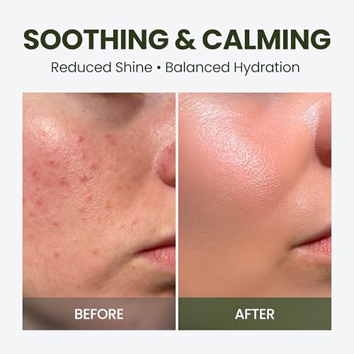 Elravie HyCicaMue Defence Cream application demonstrating soothing touch on irritated skin