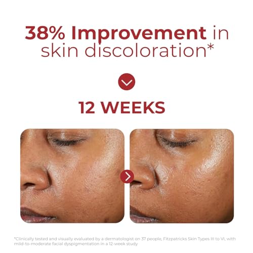 EltaMD UV Clear transparent zinc oxide finish seen on skin for balanced tone.