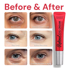 Under-eye area being treated with Enaskin Naturals eye cream for a refreshed look.