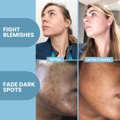 Before-and-after concept highlighting clearer skin and reduced spots.