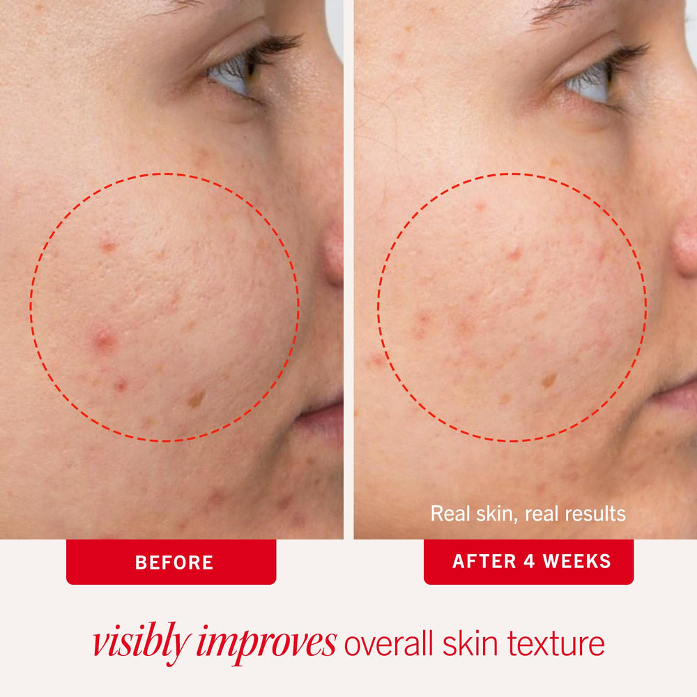 First Aid Beauty Acne Pads with 2% salicylic acid on a clean face.