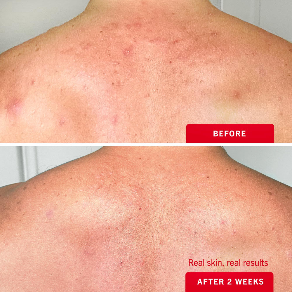 Hydrating glycerin helps maintain moisture while addressing surface blemishes.