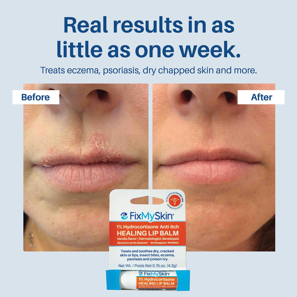 Insect bite and eczema relief with FixMySkin lip balm.