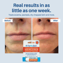 Insect bite and eczema relief with FixMySkin lip balm.