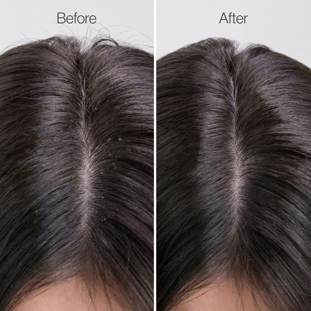 Freewill Scalp Exfoliation removes buildup for a cleaner, healthier-feeling scalp.