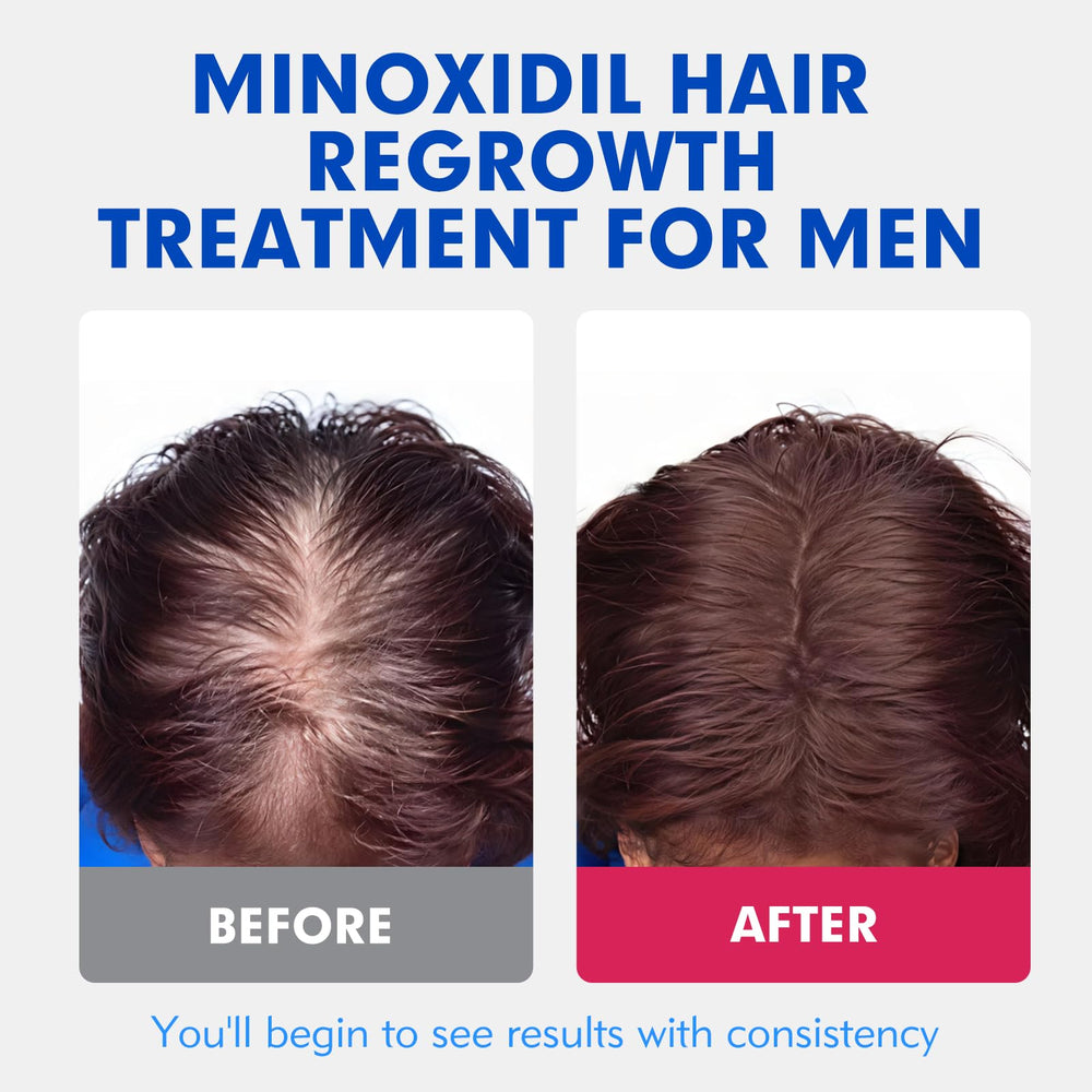 Fyntikal minoxidil beard-growth result suggesting denser facial hair