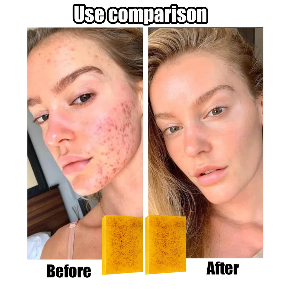 Generic lemon turmeric kojic soap with foaming net delivers dense, rich lather.