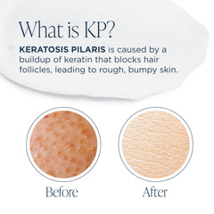 GLYTONE Glytone KP Kit shower pouf aids thorough exfoliation and refreshing cleansing.