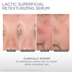 Glytone Micro-Peel being applied to the face to support retexturizing and brightness